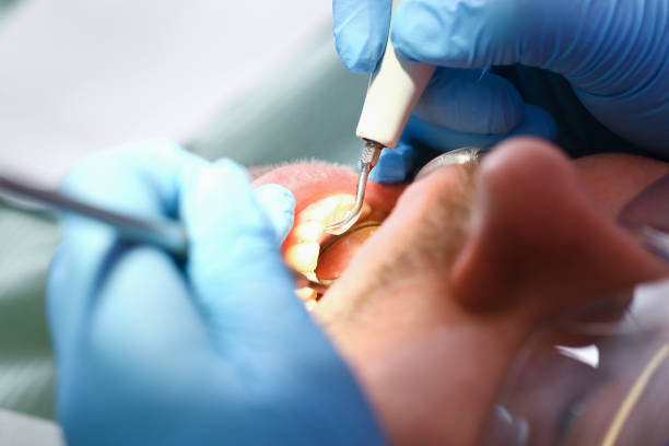 Best Emergency Wisdom Tooth Extraction in Rittman, OH